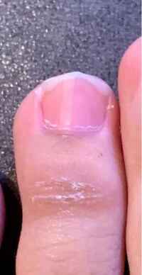 足の指に白い割れ目 カサブタ が出来るんですけど何かの病気ですか 痛くも Yahoo 知恵袋