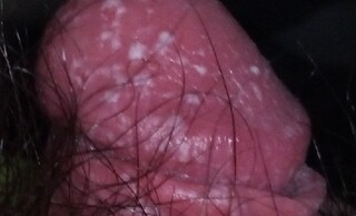 ぺ ニス 赤い 発疹 病院