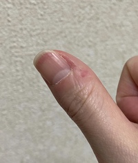 指の皮をむしってしまう癖を治したくて ネイルケアと深爪矯正専門 Yahoo 知恵袋