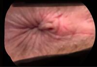 閲覧注意 高2女子です 随分前から肛門から皮 のようなものがあります Yahoo 知恵袋