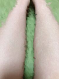 見苦しい画像失礼します 左右で脚のセルライト 脂肪 浮腫 が違いま Yahoo 知恵袋