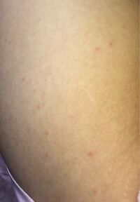 太ももにできました これは毛嚢炎でしょうか それともダニ 市販 Yahoo 知恵袋