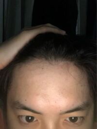 これ若禿ですよね まだ21です 元々男性ホルモンが濃く Yahoo 知恵袋