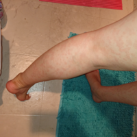 気持ち悪い画像乗ってます 汗 最近お風呂上がりに足全体に赤い斑点 Yahoo 知恵袋