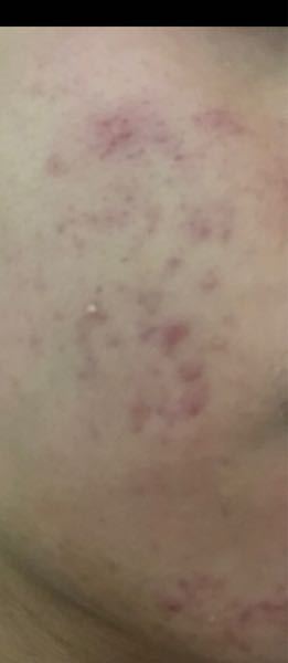 汚い画像失礼します このタイプのニキビってどうしたなら Yahoo 知恵袋
