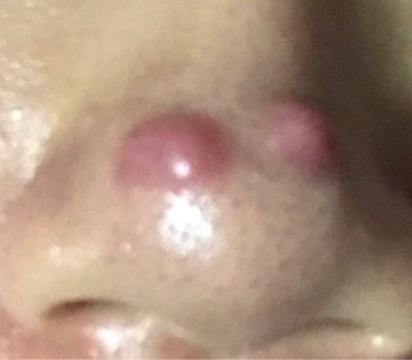 閲覧注意です ニキビ治療で美容皮膚科に通っていて ベビーピーリン Yahoo 知恵袋