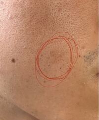 シミ肌荒れ24歳男です頬に黒ずみ シミ のような黒くなった箇所 Yahoo 知恵袋