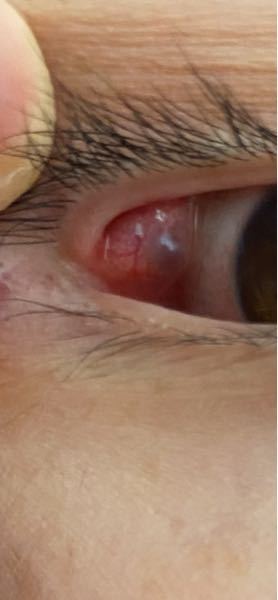 まぶたの裏 に出来物があるんですが 目尻のとこです ただの Yahoo 知恵袋