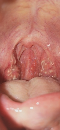 扁桃腺性病 ただの扁桃炎か、喉の性病か(口の中の画像注意)