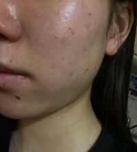 わたしは高校三年の女子です 肌荒れがひどく 特に頬の外側にニキビ跡が Yahoo 知恵袋