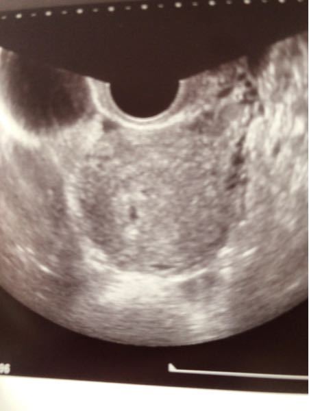 5週でポチッと映ったのですが 5週ではっきり胎嚢が確認できな Yahoo 知恵袋