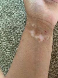 アトピーの跡で 白くなってしまいました どうやったら治ると思いますか Yahoo 知恵袋