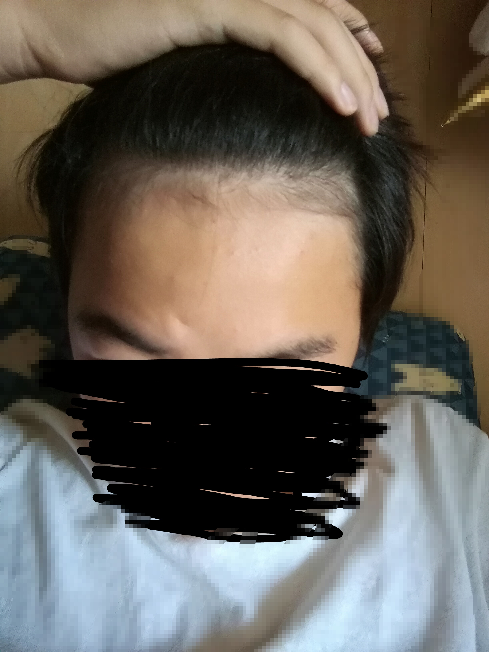 高1です 生え際に産毛が多いんですがこれ禿げてきてますか Yahoo 知恵袋