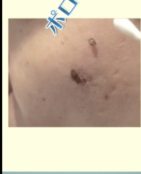 シミってこんなふうにポロっと取れるのですか 化粧品の広告みたい Yahoo 知恵袋