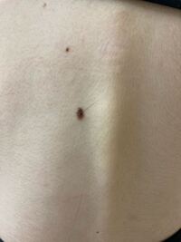 この黒子から出ている毛は抜いた方がいいですか あと この黒子は悪性 Yahoo 知恵袋