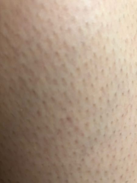 70以上 毛穴 埋没