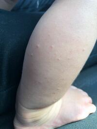 子供の腕に出来る無色の発疹について 画像注意 7歳の息子の腕に出来 Yahoo 知恵袋