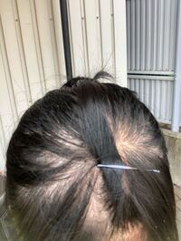 今の髪型のせいもあるかもそれませんが高校生でこの髪の量 ハゲぐわいって Yahoo Beauty