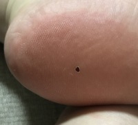 2週間前くらいに突然ほくろができました 足の裏にほくろができると癌と聞い Yahoo 知恵袋