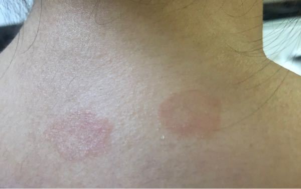 至急お願いします 首にこのような斑点が突然できたのですがこ Yahoo 知恵袋