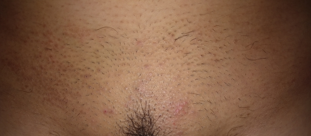 陰毛部 に関するq A Yahoo 知恵袋