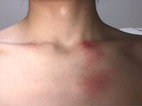最近鎖骨あたりに知らぬ間に赤く擦ったようなのができます Yahoo 知恵袋
