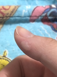 手持ち花火で指を火傷し 水ぶくれができ 色が白くなりました 痛みはない Yahoo 知恵袋