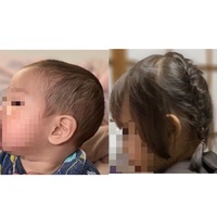 3歳の子の頭の形は治りますか 現在3歳の子供がいるのですが後頭部が絶壁 Yahoo 知恵袋