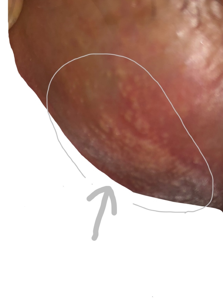 突然性器の小陰核にできもの？が出来ていました。ザラザラ感は少し 