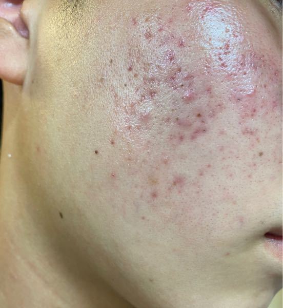 ニキビケア すべての質問 Yahoo 知恵袋