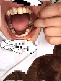 この酷い虫歯全部でいくらで直せると思いますか 17歳女で Yahoo 知恵袋