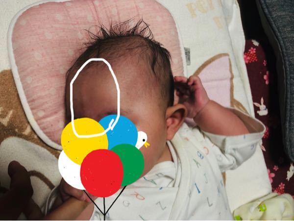 生後3ヶ月の娘のおでこに 縦で盛り上がっている線があります Yahoo 知恵袋