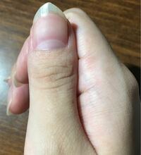 私の指はマムシ指ですか 全ての指が太くて短く 特に親指が酷いです Yahoo 知恵袋