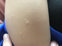 虫刺され 子供の左ももに 4つほど水膨れの様だけど 固い透明の Yahoo 知恵袋