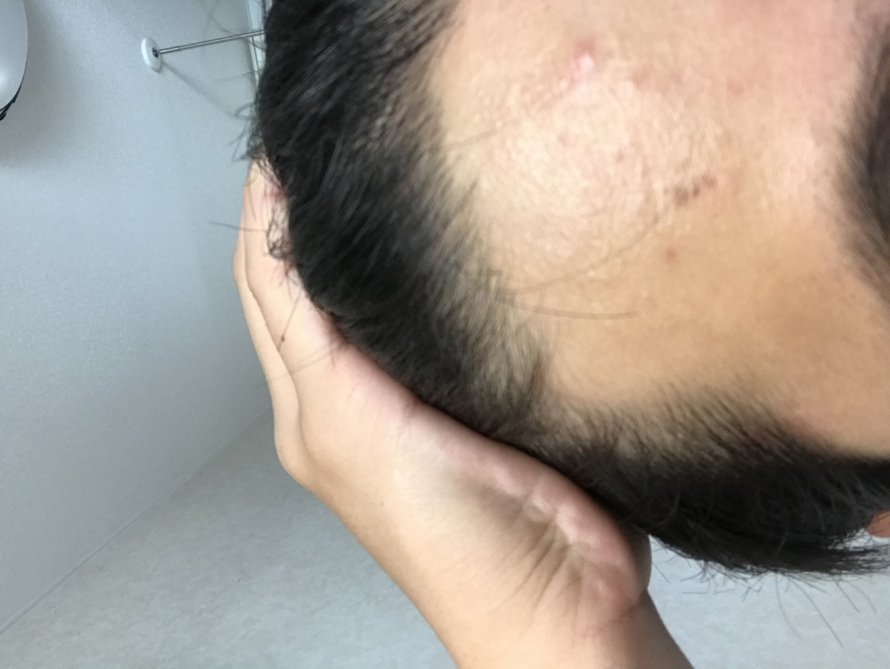 高校一年生です最近前髪が後退してきたような気がします これはハゲですか Yahoo 知恵袋