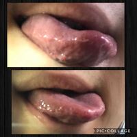 赤い ぶつぶつ 舌 舌に赤いぶつぶつがある場合は要注意！溶連菌感染症