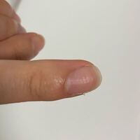 こんな感じで爪がぼこぼこしてます 写真わかりずらくてすみ Yahoo 知恵袋