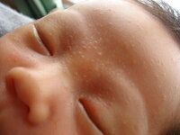 生後３週間の赤ちゃんの眉間 耳 目のまわり 顎に写真のような湿 Yahoo 知恵袋