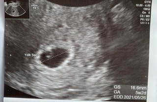 胎嚢 のみ 週 6