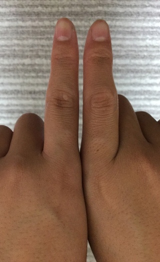 ソフトボールで指先にボールが当たって人差し指の第2関節が腫れています 曲 Yahoo 知恵袋