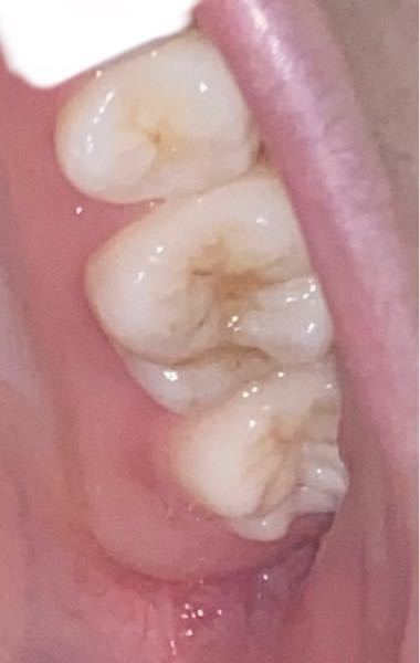 この歯は虫歯でしょうか 痛みはなく 歯を叩いてみてもなんともない Yahoo 知恵袋