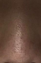 鼻の毛穴が広い箇所が何箇所かあって 本当に気持ち悪いです 1つの毛穴だけ Yahoo 知恵袋