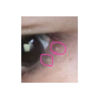 自分で潰す 霰粒腫