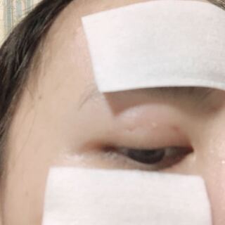 昨日二重埋没をしました 写真あり 3点どめです 今日縫い目の一部 Yahoo 知恵袋