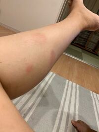 足にこのよいな斑点が沢山あります 左にもあります 虫ささ Yahoo 知恵袋