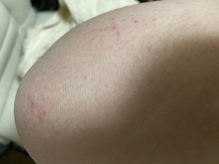 膝がこのように赤いぶつぶつのようなものができているのですが 虫刺されでし Yahoo 知恵袋