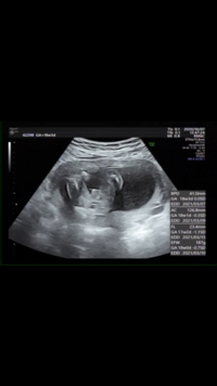 18週３日のエコー写真です 前回はシンボルがついてなさそうだから女の子か Yahoo 知恵袋