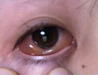 恐怖映像のような画像ですみません笑 目が異常に痒くてゴシゴ Yahoo 知恵袋