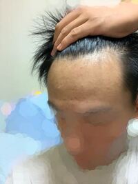 21歳ですm字がどんどん来てる気がします 1年ほど前に投稿した写真より進 Yahoo 知恵袋