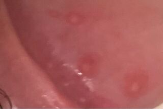 ぺ ニス 赤い 発疹 病院